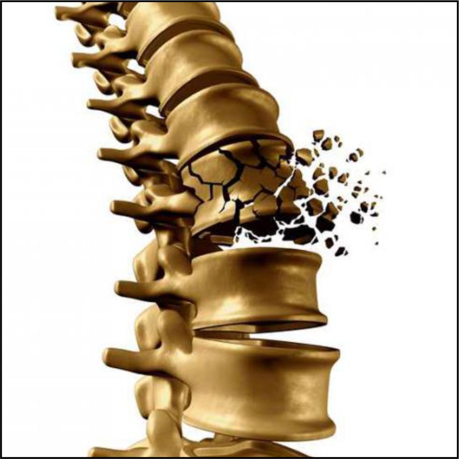 Fragility or Osteoporosis Fractures