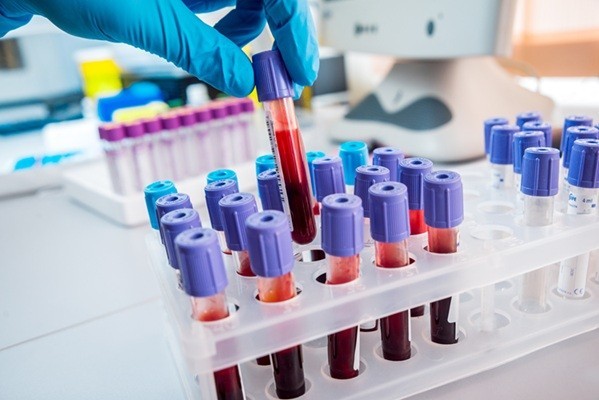 Blood samples prepared for laboratory testing
