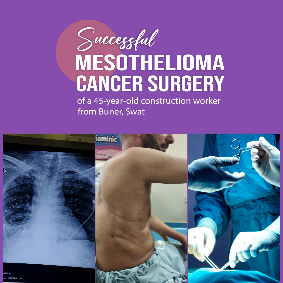 Successful Mesothelioma Cancer Surgery