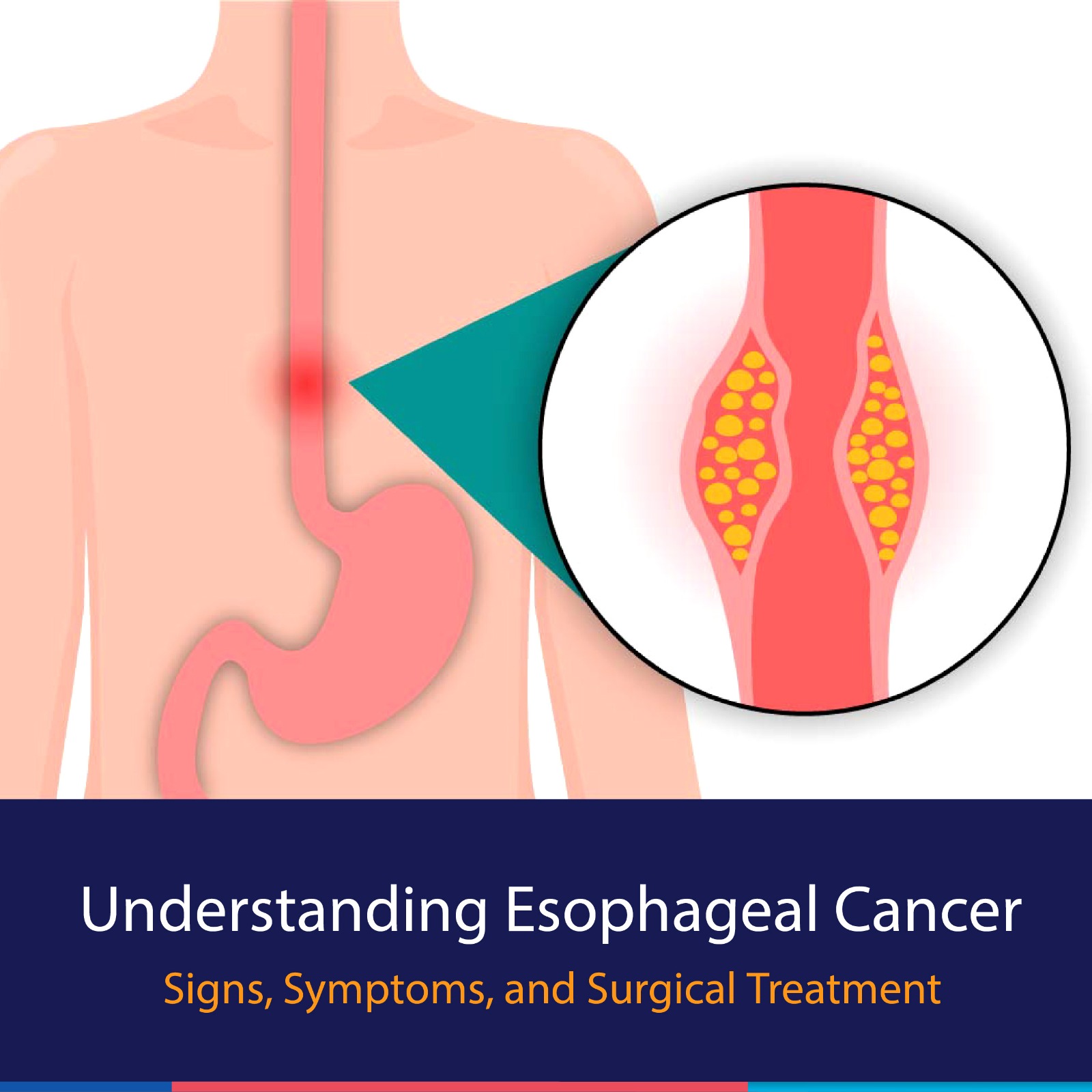 Understanding Esophageal Cancer: Signs, Symptoms, and Surgical Treatment